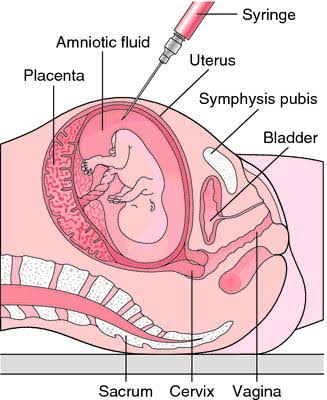 Amniocentesis