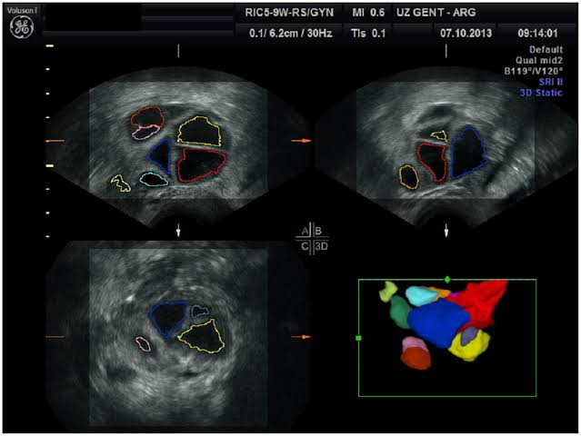 Folliculometry