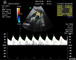 7. fetal doppler