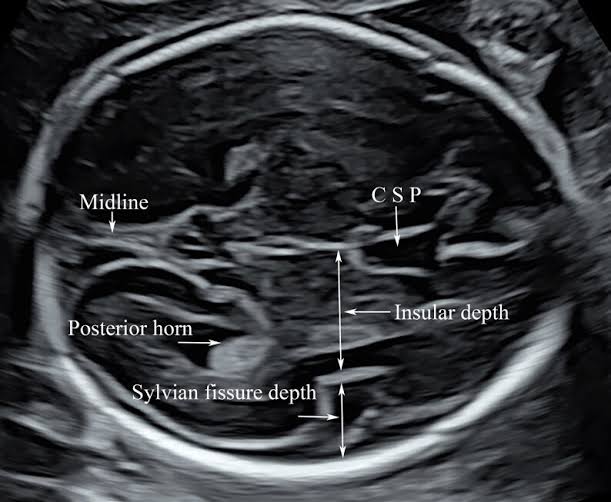 fetal neurosonogram