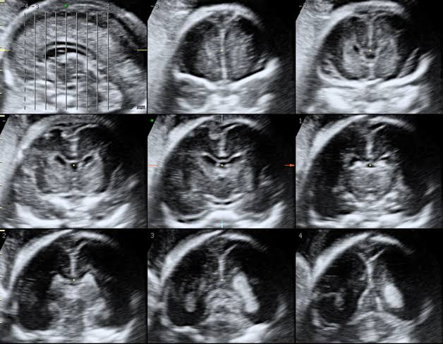 fetal neurosonogram