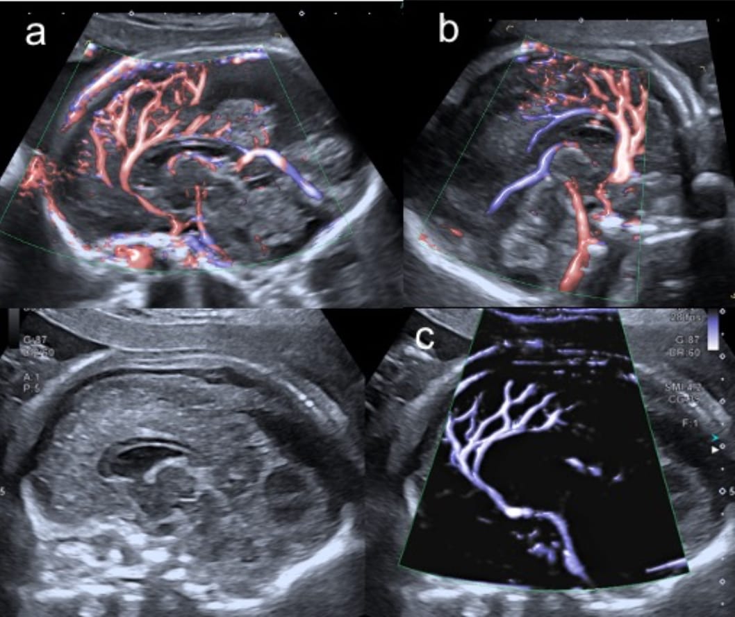 fetal neurosonogram